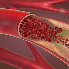 العلماء يحددون أخيرا الآلية الغامضة المسببة لتصلب الشرايين
